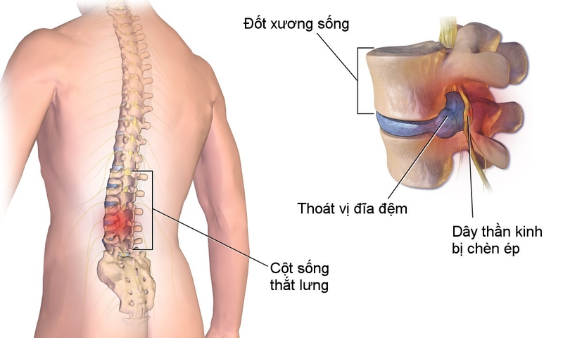 Chớ lơ là triệu chứng đau vùng mông gần xương cụt 2