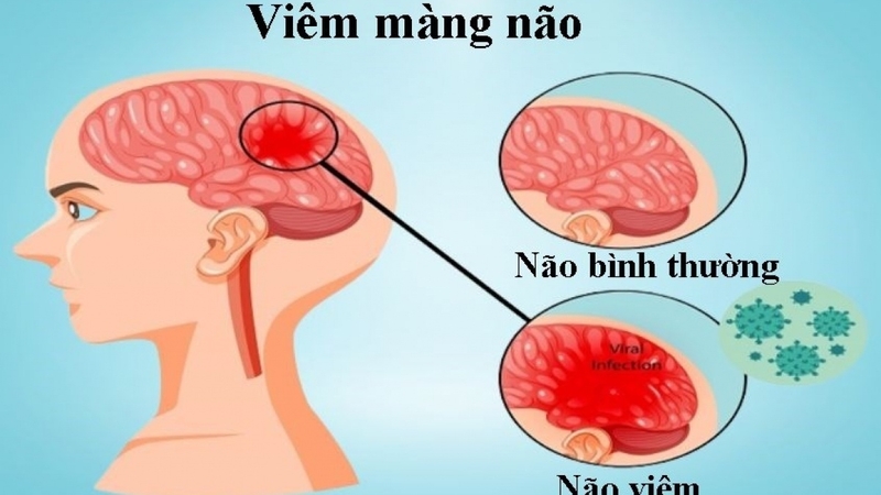 Chọc dò tủy sống có đau không, có ảnh hưởng gì không 3