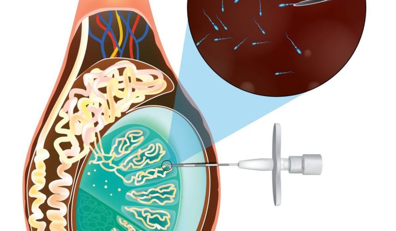 Chọc hút tinh trùng từ tinh hoàn qua da (TESA): Ưu và nhược điểm 1