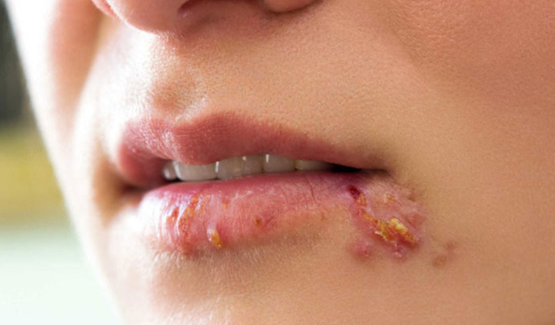 Chốc lở mép miệng là gì?
