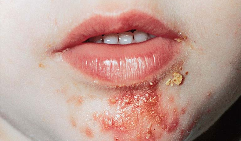 Nguyên nhân gây chốc lở thể mủ