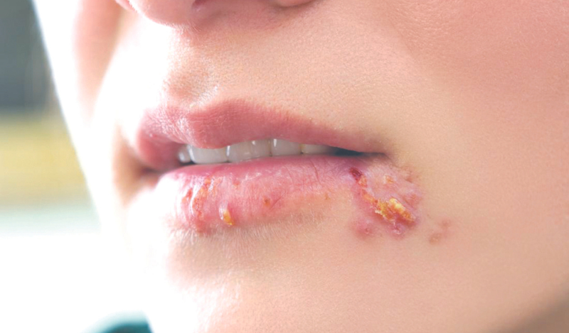 Chốc lở thể mủ có nguy hiểm không?