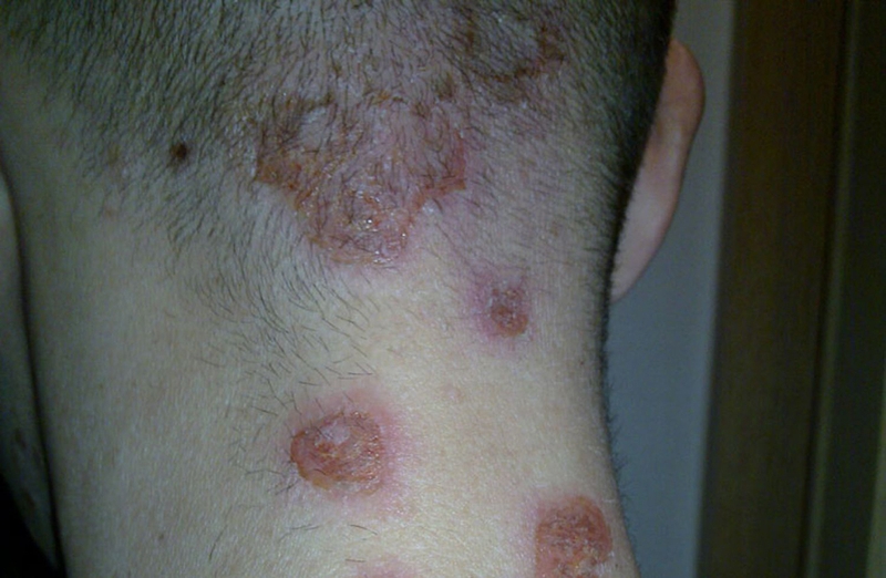 Chốc lở trên đầu có nguy hiểm không? Nguyên nhân và cách chữa trị 1