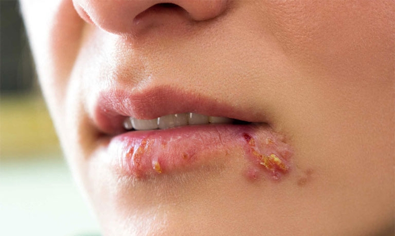 Chốc mép là gì? Nguyên nhân và cách chữa trị nhanh chóng tại nhà