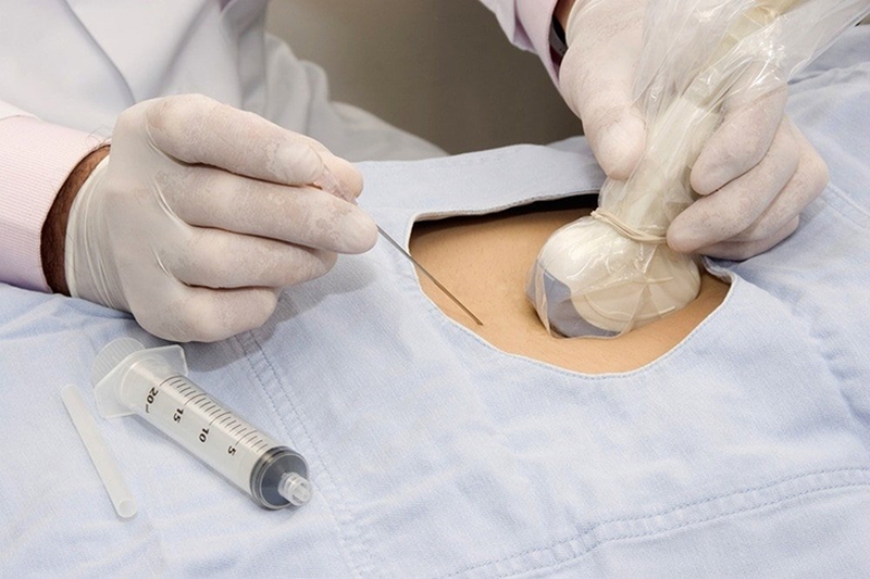 Chọc ối có đau không? Thời gian chọc ối phù hợp nhất các mẹ bầu nên biết 3