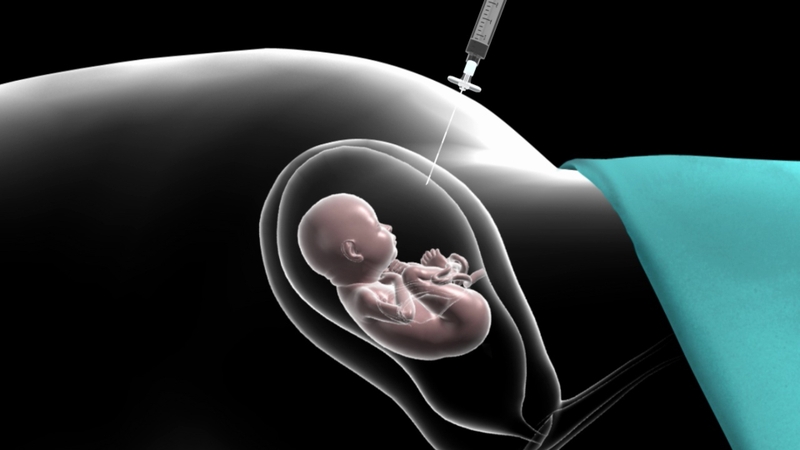 Chọc ối thường được chỉ định khi có nghi ngờ bất thường về di truyền hoặc dị tật bẩm sinh ở thai nhi