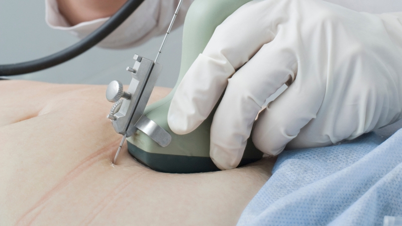 Dưới hướng dẫn trực tiếp bằng siêu âm, bác sĩ dùng kim nhỏ, dài xuyên qua thành bụng và tử cung để vào túi ối