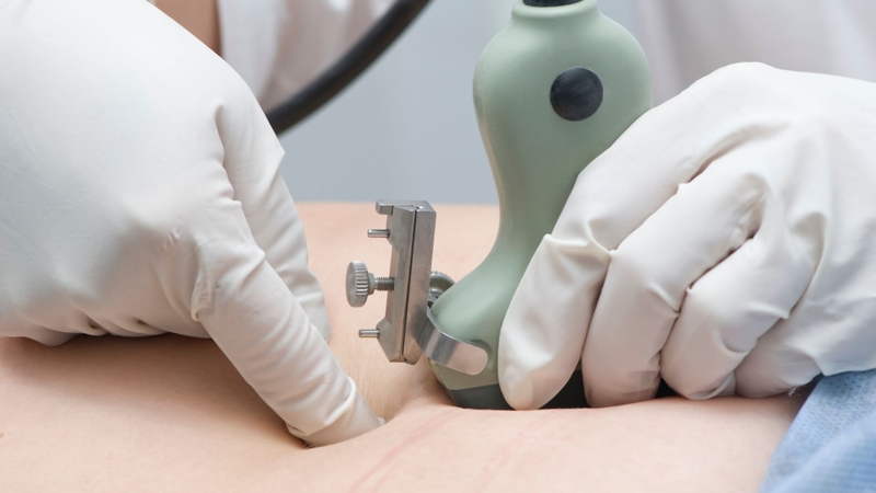 Bác sĩ sẽ dùng dụng cụ chuyên dụng để lấy ra một lượng dịch ối nhỏ đem đi xét nghiệm