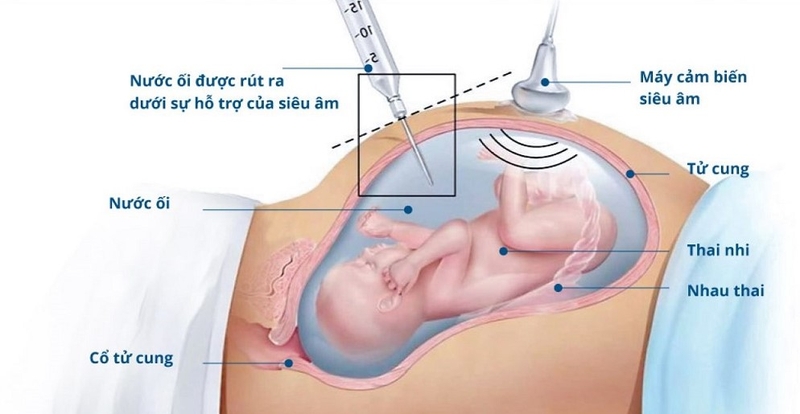 Chọc ối là gì? Phương pháp chọc ối có nguy hiểm không? 1