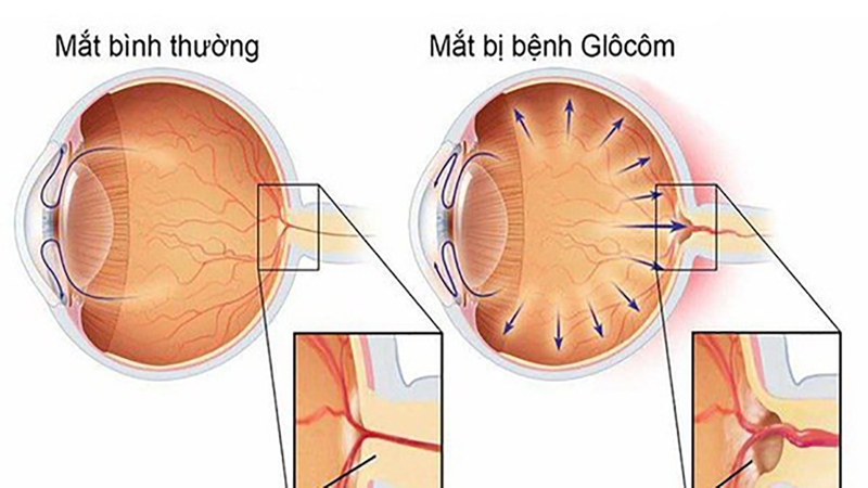 Bệnh&nbsp;glôcôm được chia thành hai loại chính:&nbsp;glôcôm&nbsp;góc mở và glôcôm góc đóng