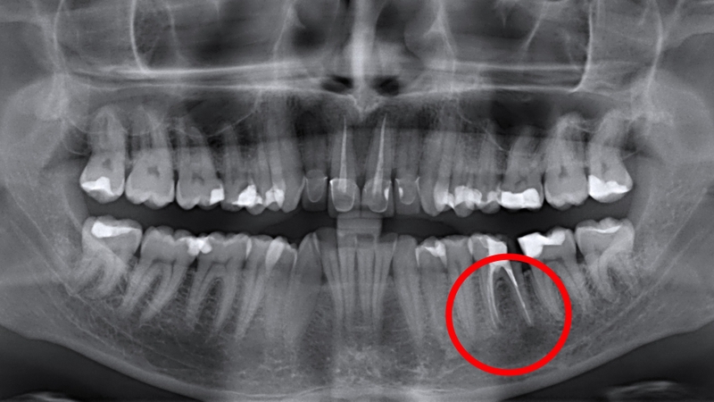 chop-rang-la-gi-vai-tro-cua-chop-rang-trong-suc-khoe-rang-mieng 1