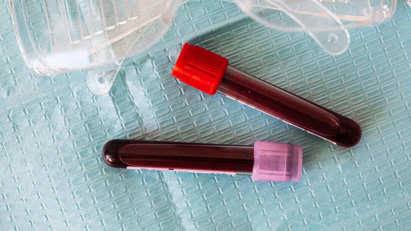 Xét nghiệm huyết thanh học chủ yếu dùng trong nghiên cứu dịch tễ hoặc sàng lọc cộng đồng