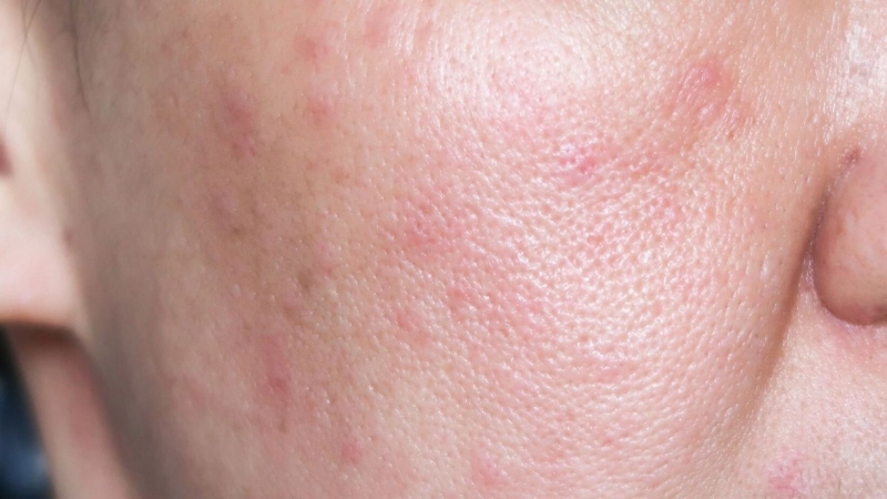 Chu trình skincare cho da nhạy cảm cực chi tiết! 1