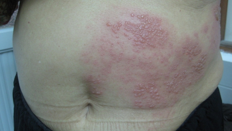 Chữa bệnh giời leo bằng Tây y có hiệu quả không? 2