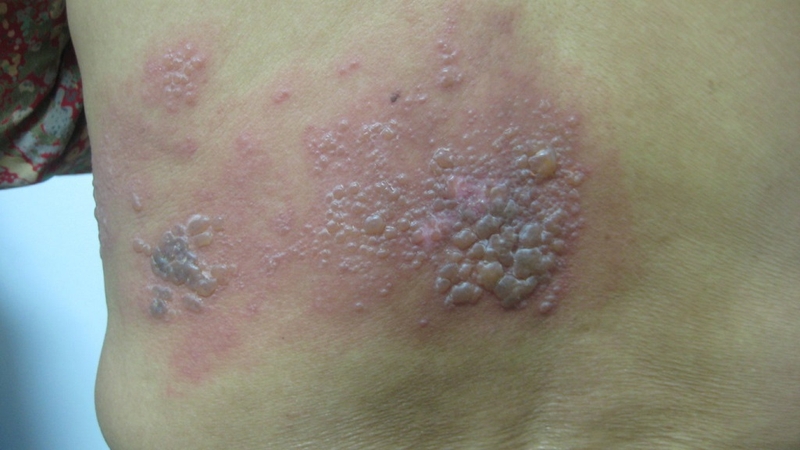 Cách chữa bệnh giời leo bằng Đông y hiệu quả không tác dụng phụ 1