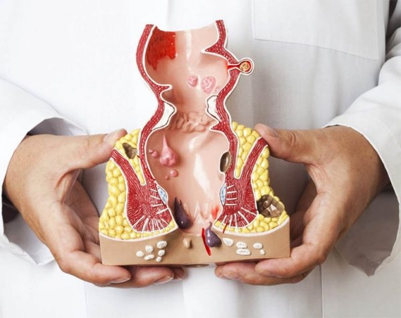 Hình ảnh bệnh trĩ nội và bệnh trĩ ngoại theo 4 cấp độ 2