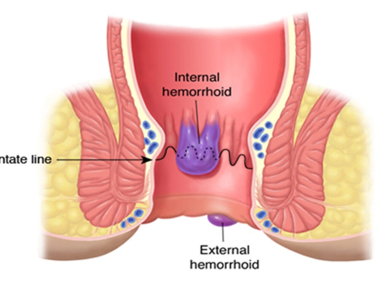 Chữa bệnh trĩ ngoại không cần phẫu thuật và biện pháp phòng ngừa bệnh trĩ ngoại 1