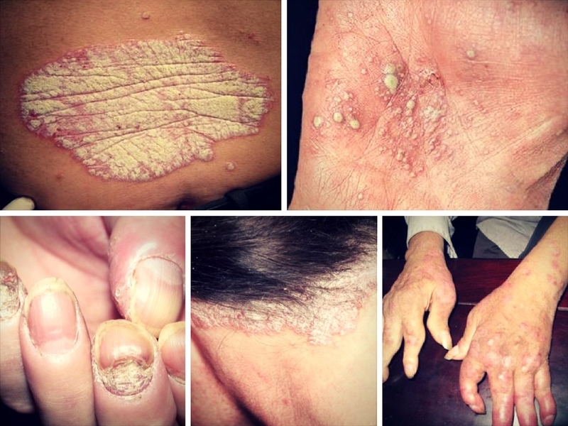 Cách chữa bệnh vẩy nến bằng cây lược vàng 1