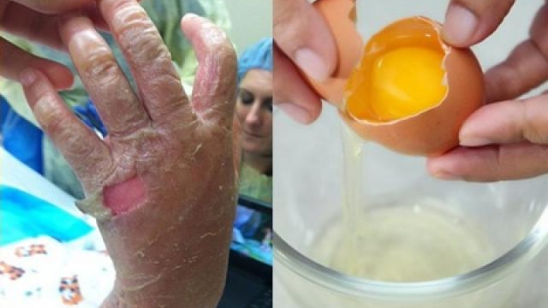 Chữa bỏng bằng lòng trắng trứng hiệu quả ngay tại nhà 2