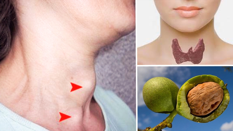 Chữa bướu cổ bằng quả óc chó với mật ong hiệu quả bất ngờ 3