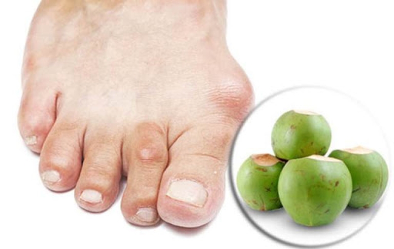 Lá trầu không và nước dừa chữa gout có tốt không?