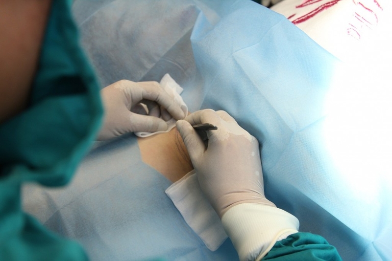 Chữa hôi nách phẫu thuật có đau không?-1