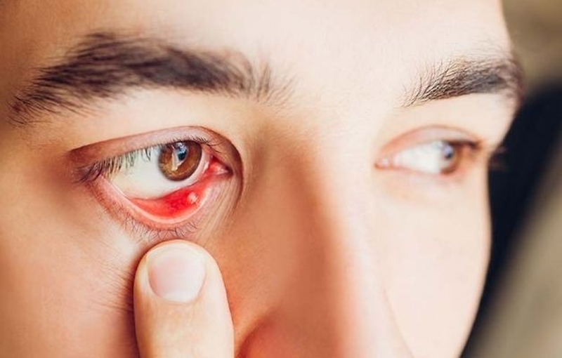 Người mổ chắp mắt bao lâu thì khỏi hẳn? 1