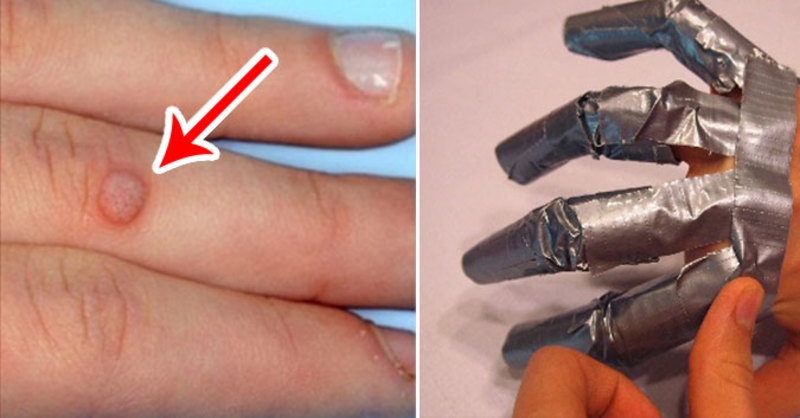 Vài nét về phương pháp chữa mụn cóc bằng băng keo 3