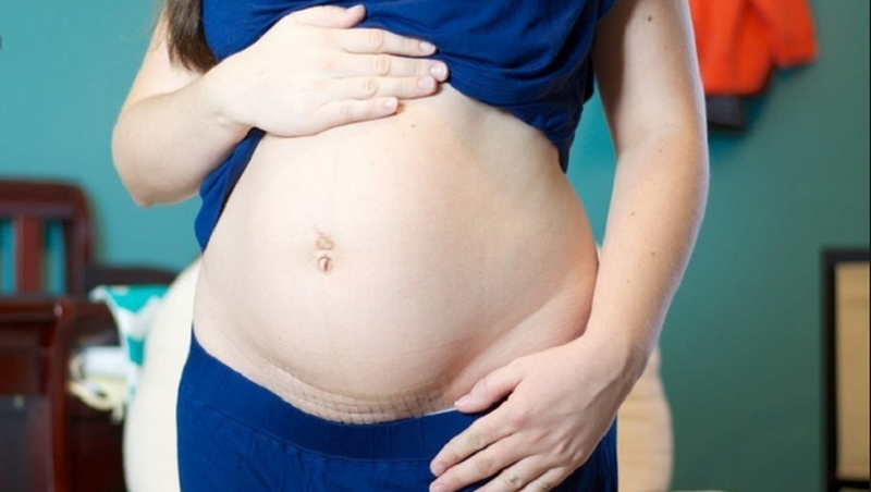 Chửa ở vết mổ có nguy hiểm đến sức khỏe không?2