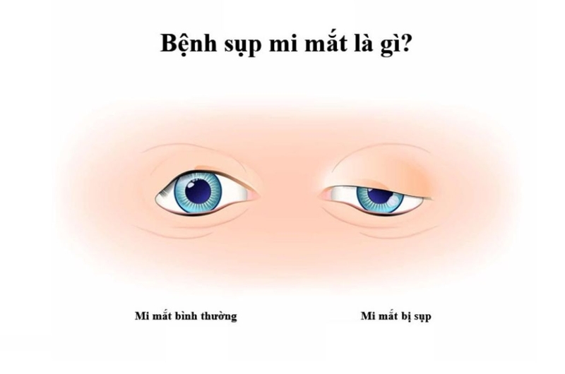 Chữa sụp mí bẩm sinh tại nhà bằng cách nào hiệu quả 1