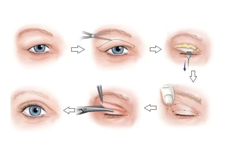 Chữa sụp mí bẩm sinh tại nhà bằng cách nào hiệu quả 4