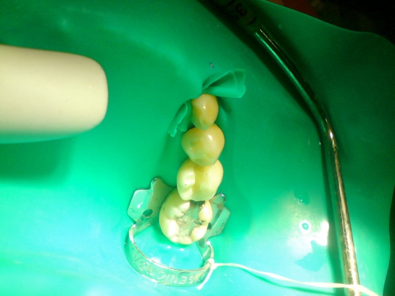 Chữa tủy răng có đau không và ai nên chữa tủy răng? 3