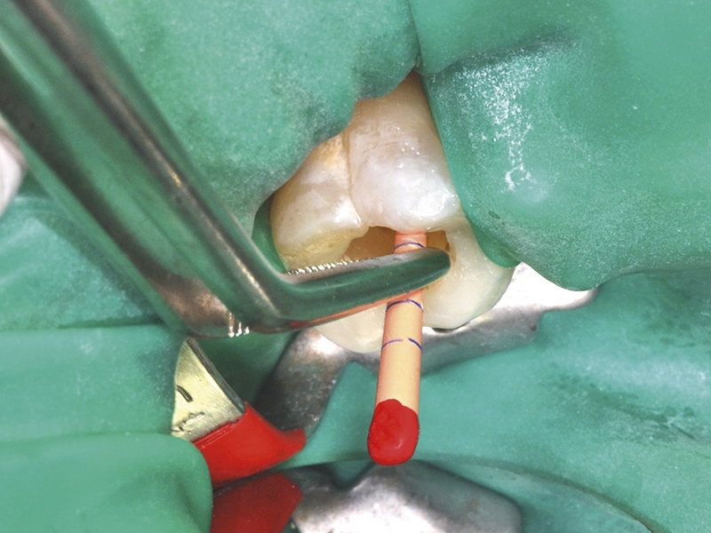 chữa tủy răng số 7 2