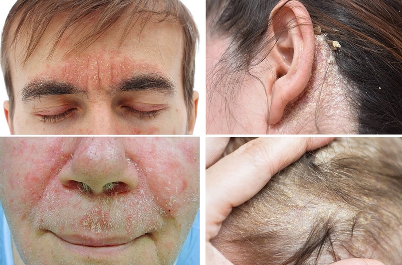 chữa viêm da tiết bã bằng dân gian 1