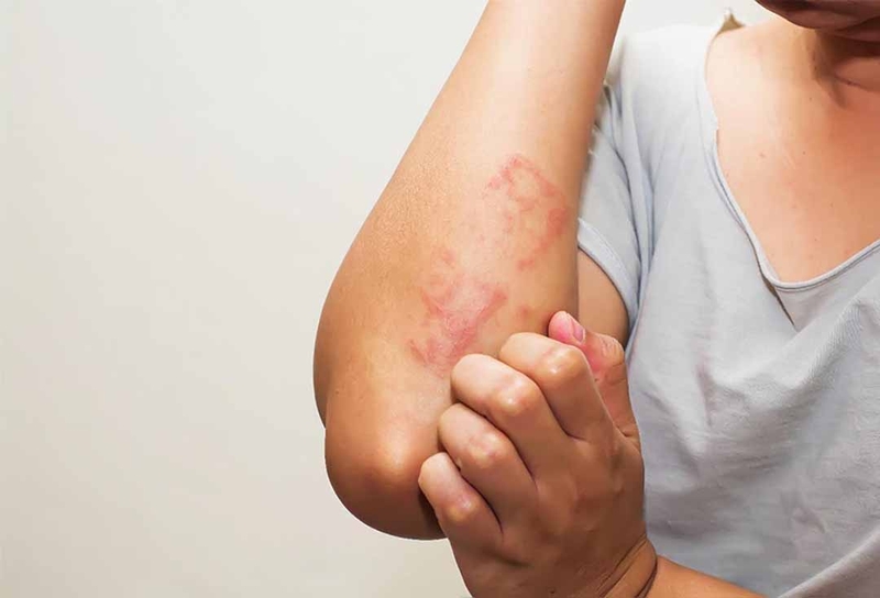 Hội chứng Steven-Johnson với phát ban dạng hồng