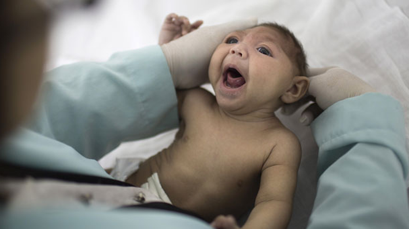 Chứng đầu nhỏ, căn bệnh nguy hiểm với trẻ sơ sinh