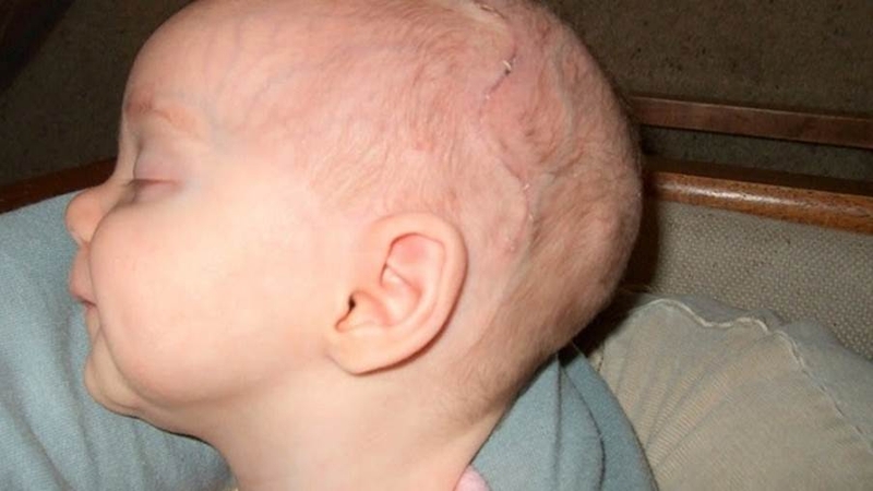 Chứng dính liền khớp sọ sớm là gì? Nguyên nhân, triệu chứng và cách điều trị 4