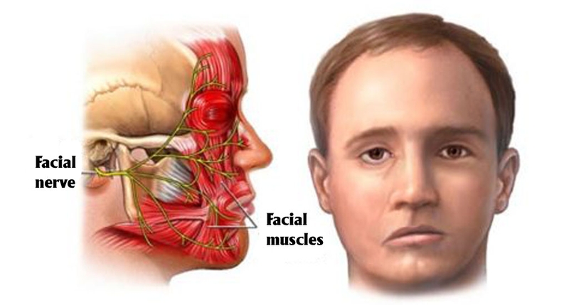 Chứng liệt dây thần kinh số 7 có tái phát không?