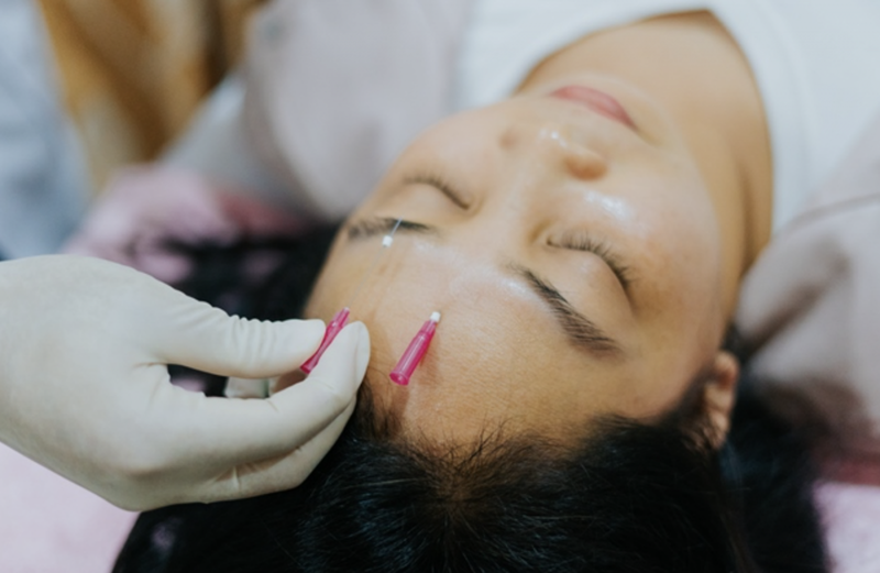 Chứng liệt dây thần kinh số 7 có tự khỏi không?