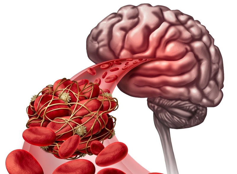 Chứng mất ngôn ngữ và những điều cần biết 5