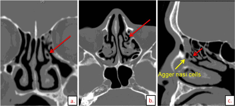 Tìm hiểu những thông tin cần thiết về Chụp CT xoang mũi 3