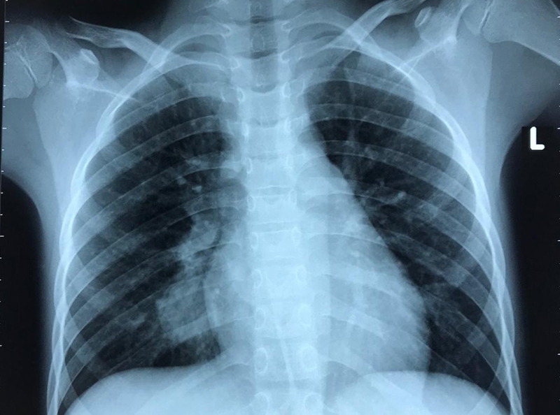 Chụp cắt lớp phổi để làm gì Các bước thực hiện ra sao 1