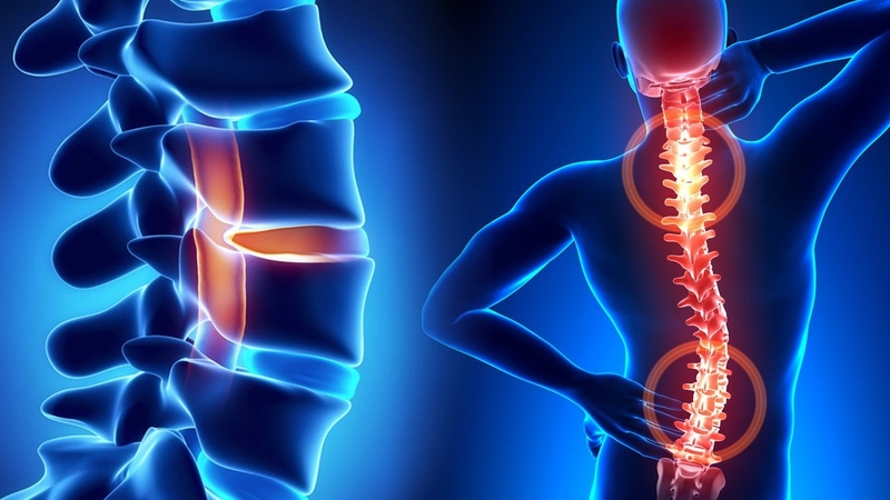 Thắc mắc: Khi nào cần chụp cộng hưởng từ cột sống thắt lưng? 2