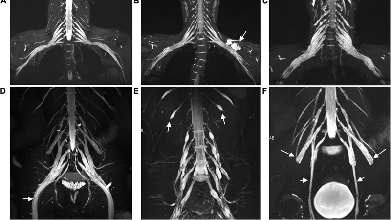 Chụp cộng hưởng từ dây thần kinh phát hiện những bệnh lý nguy hiểm nào? 2