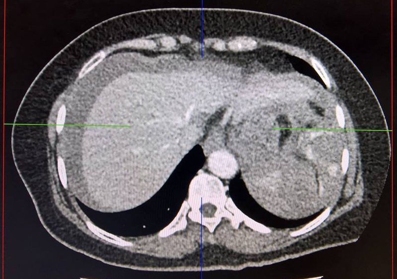 Chụp CT bụng là gì? Cần lưu ý gì khi chụp và chi phí bao nhiêu? 2
