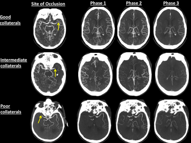 Chụp ct mạch máu não là gì? Ưu điểm của phương pháp này so với chụp MRA 1