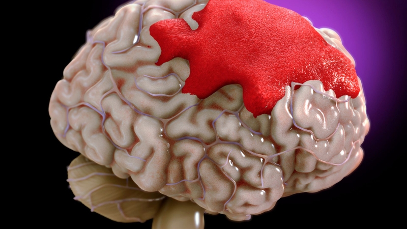 Chụp CT não giá bao nhiêu? Tầm soát đột quỵ não thế nào? 1