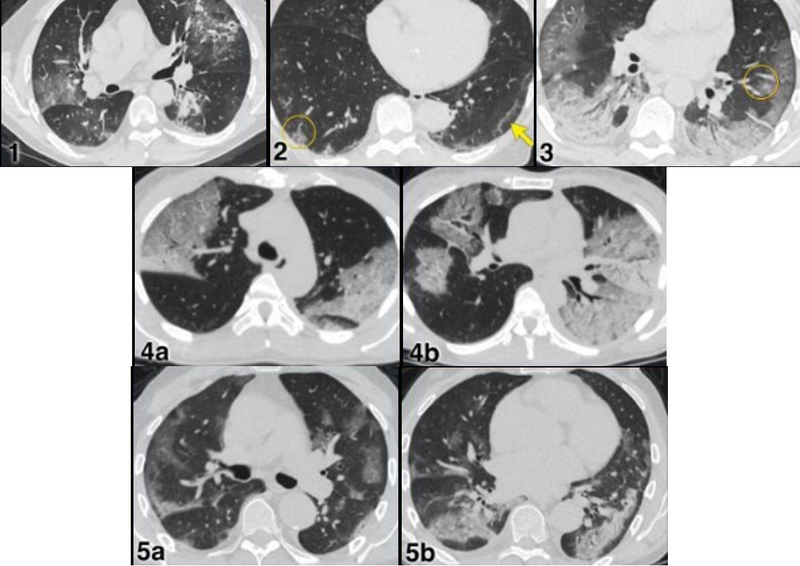 Chụp CT phổi là gì? Cần biết gì trước khi chụp CT phổi? 3