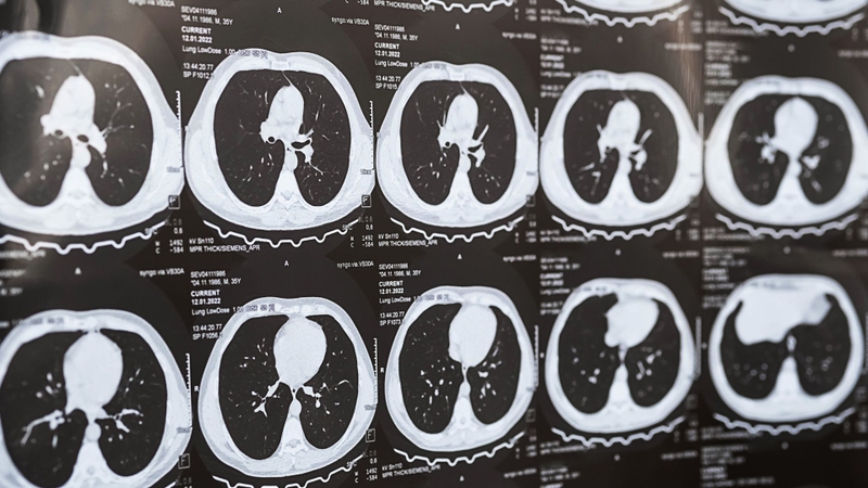 CT phổi là phương pháp rất hiệu quả trong phát hiện tổn thương nghi ngờ ung thư phổi