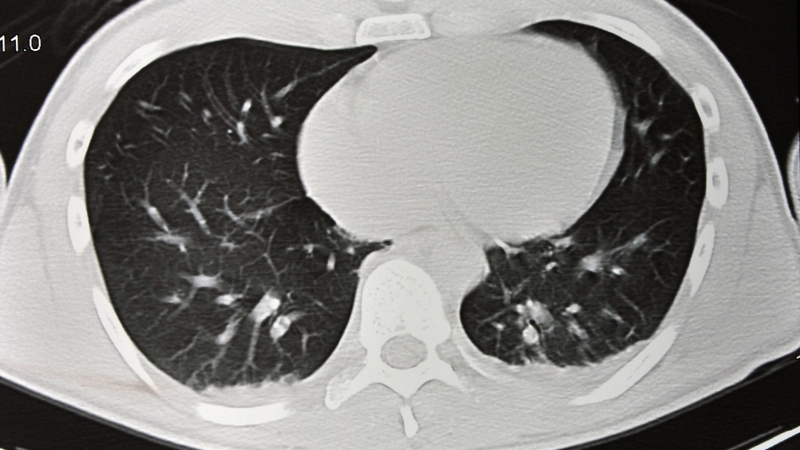 Chụp CT phổi giúp phát hiện ổ áp xe, tràn dịch màng phổi hoặc tổn thương lan rộng